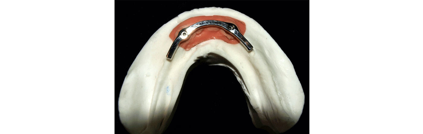 SliderSobreImplantes1